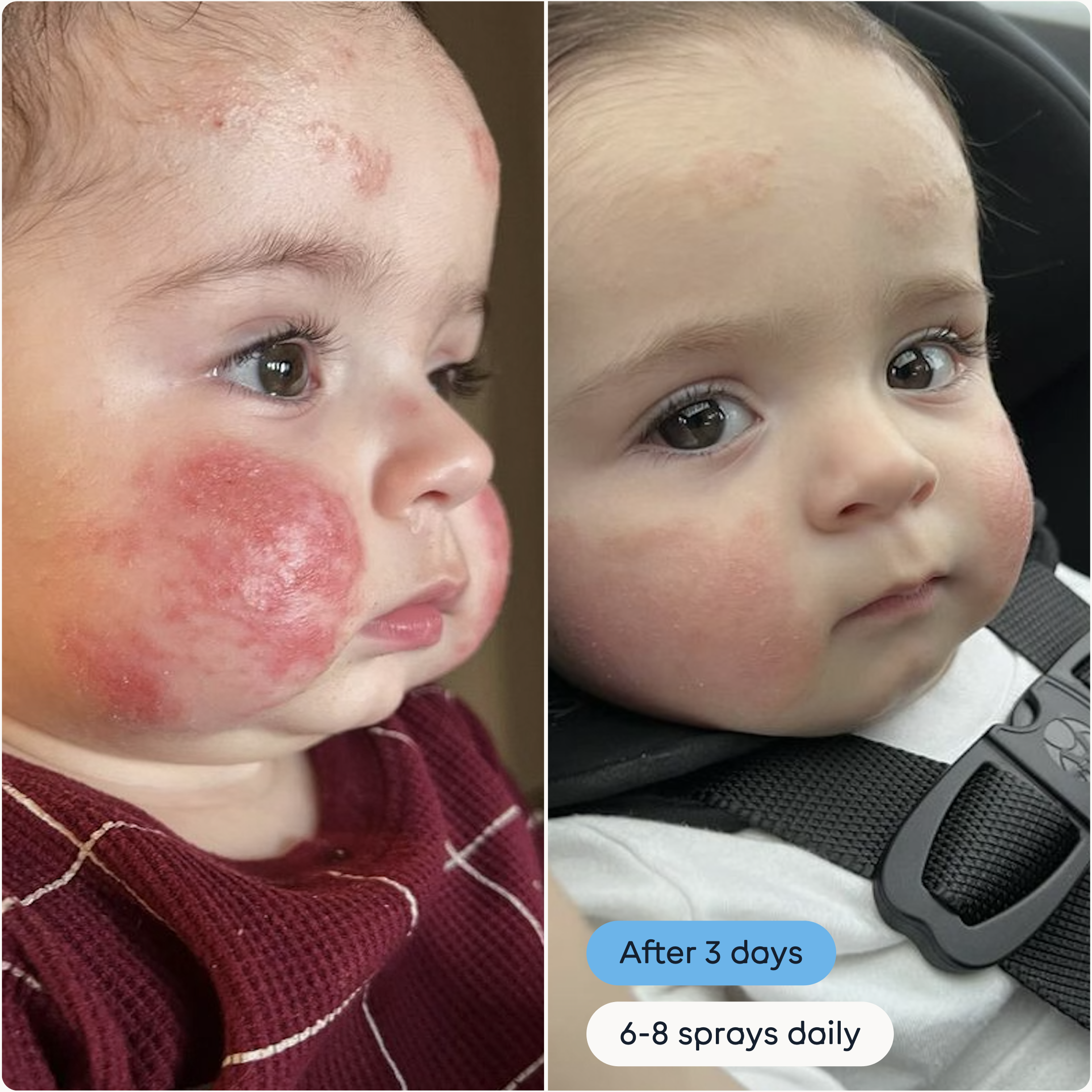 Hypochlorous Acid Antimicrobial Skin Spray