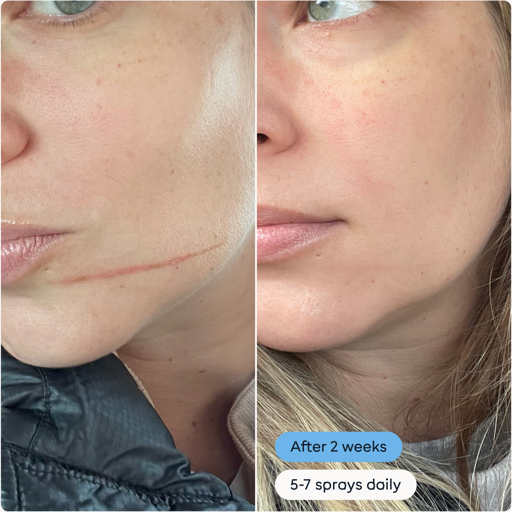 Hypochlorous Acid Antimicrobial Skin Spray