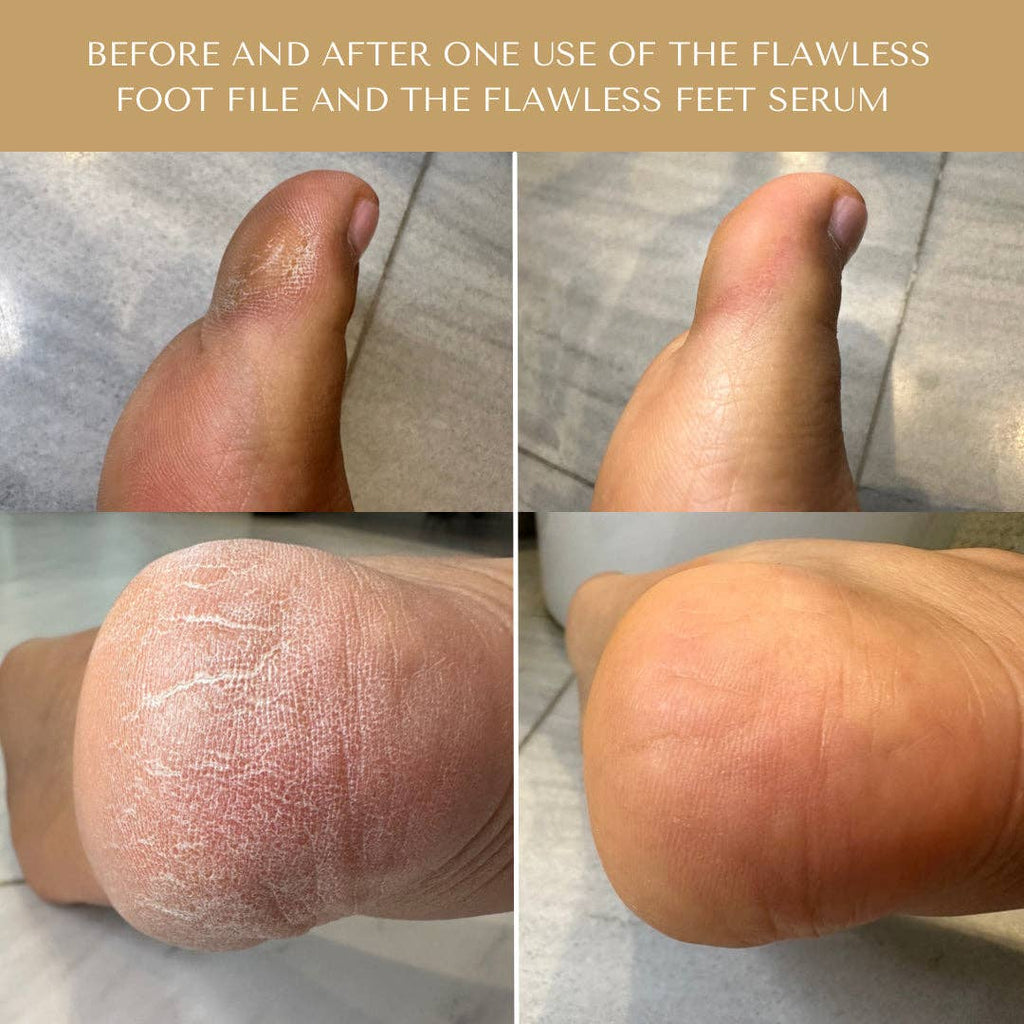 Flawless Feet System