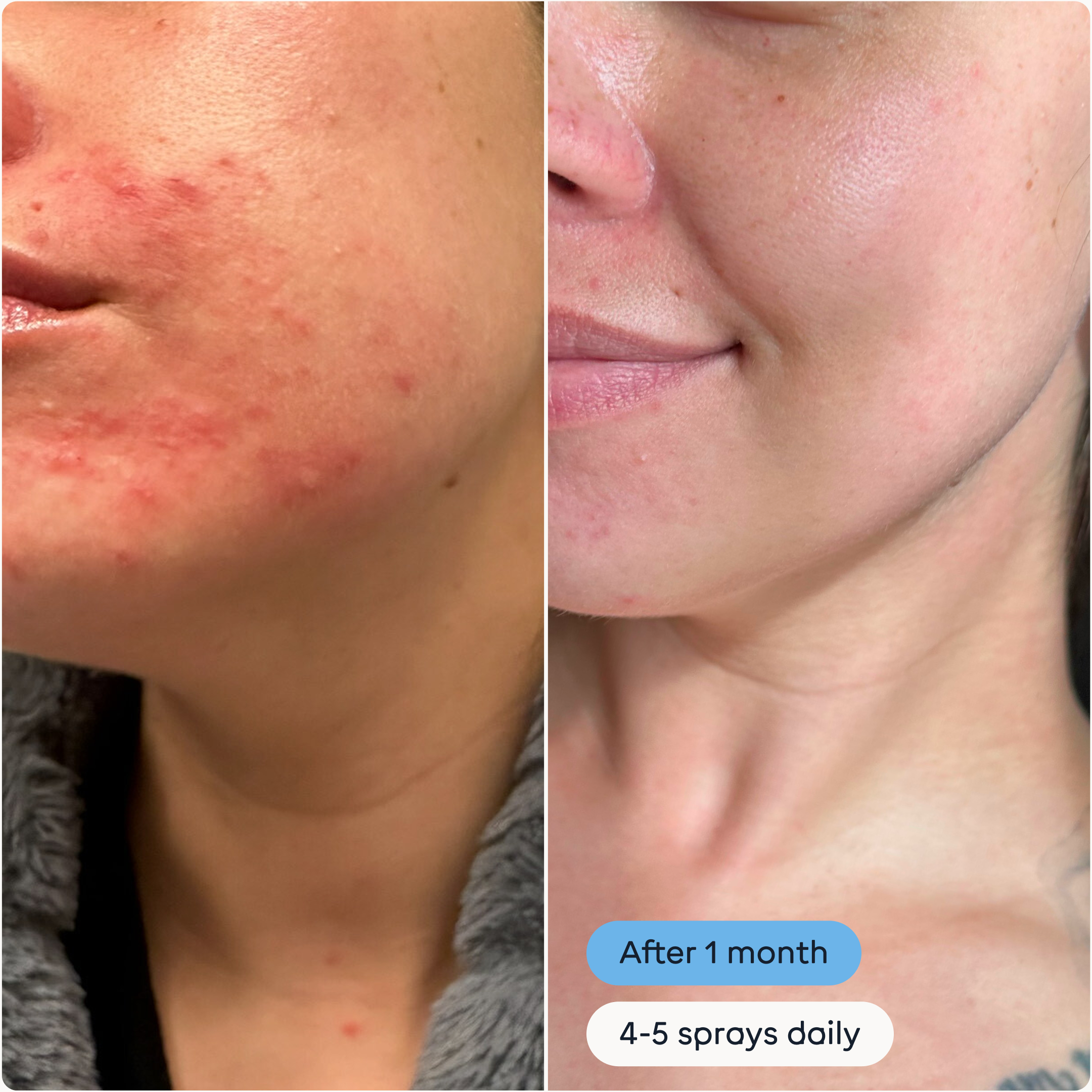 Hypochlorous Acid Antimicrobial Skin Spray