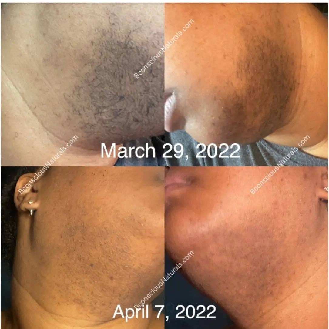 Bye Bye Hair Removal Oil – Organic Herbal Formula for Chin & Body Hair