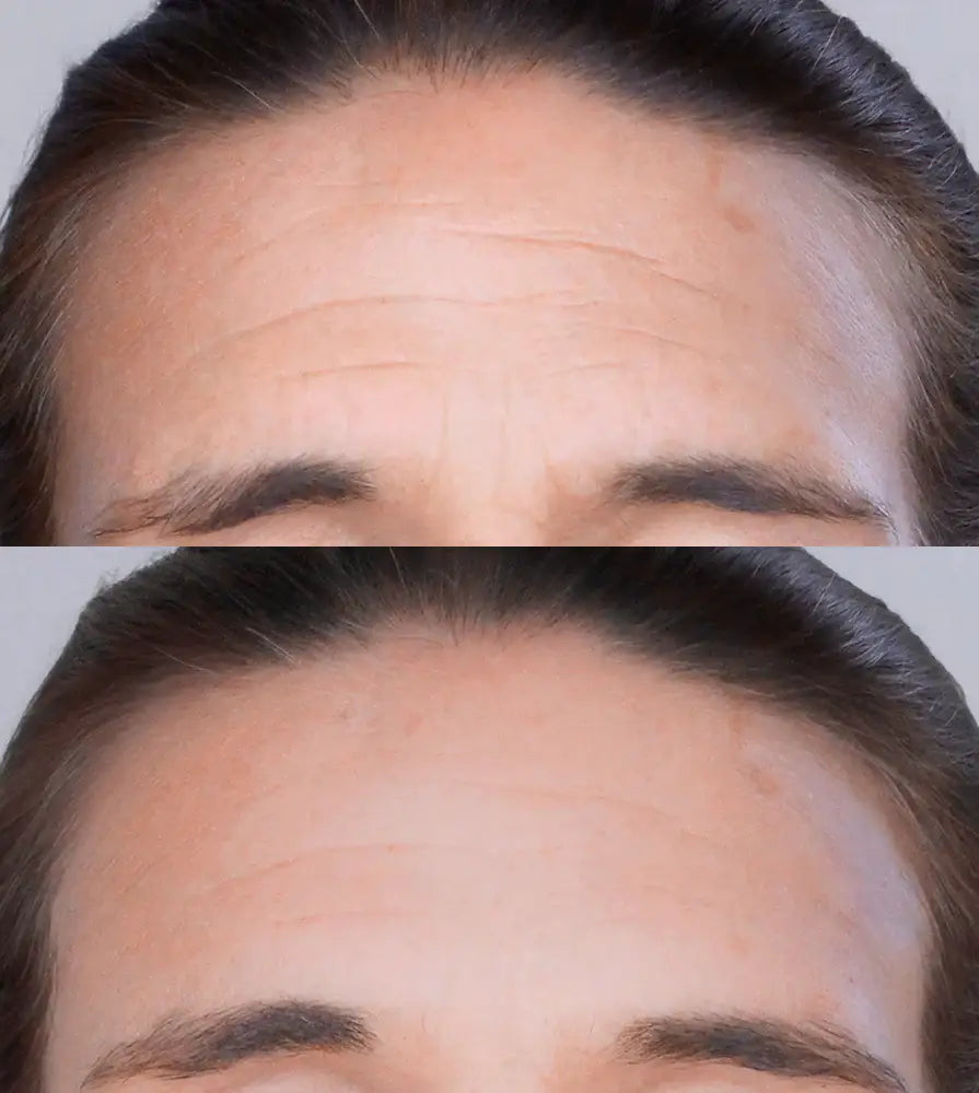 Instant Wrinkle Filler